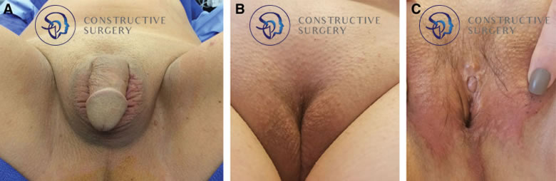 reassignment surgery male to female before and after